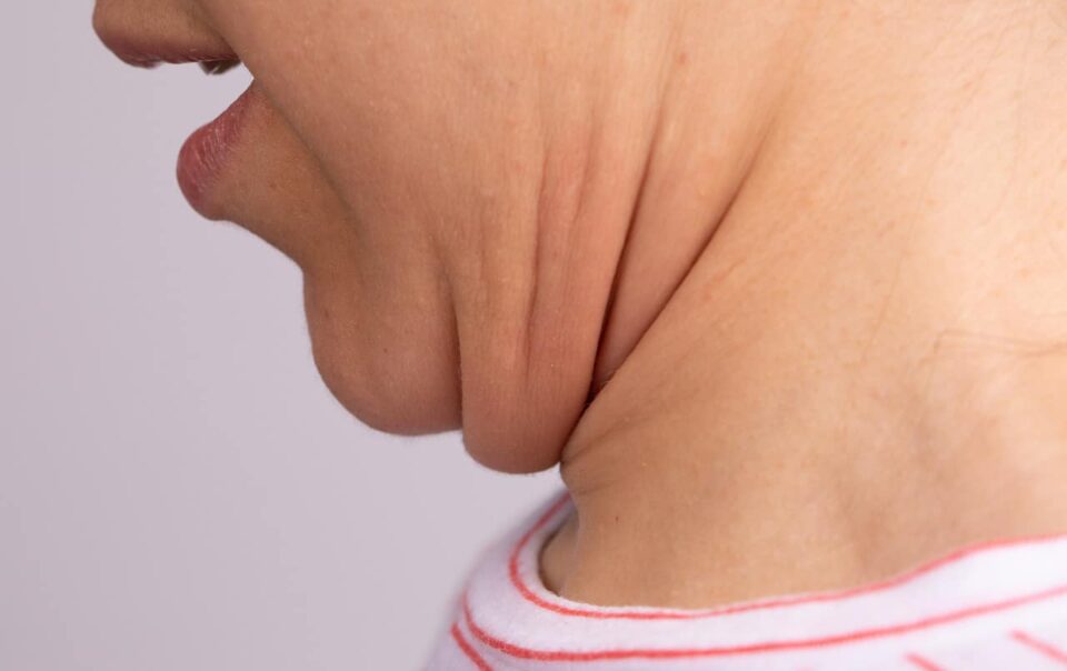 neck-fat:-causes,-implications-and-corrective-tips:-healthifyme